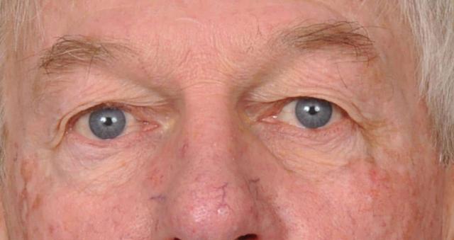 Blepharoplasty before at Edmon P. Khoury, MD in Greenwood Village, CO