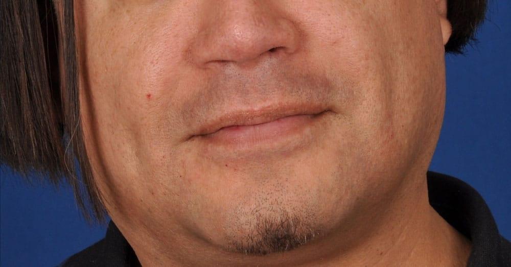 Edmon P. Khoury, MD buccal fat removal after — Greenwood Village, CO
