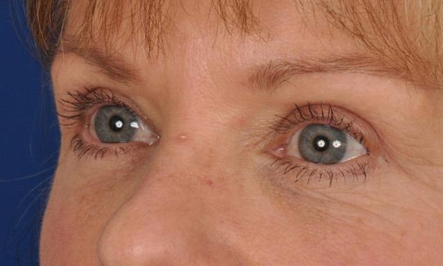 Blepharoplasty after at Edmon P. Khoury, MD in Greenwood Village, CO