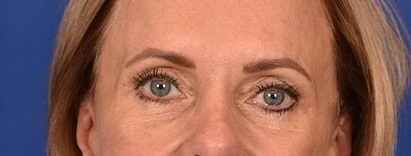 Blepharoplasty after at Edmon P. Khoury, MD in Greenwood Village, CO
