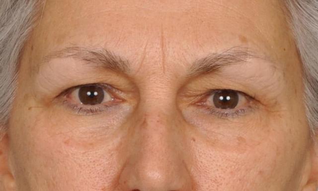 Blepharoplasty before at Edmon P. Khoury, MD in Greenwood Village, CO