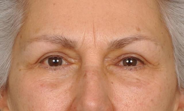 Blepharoplasty after at Edmon P. Khoury, MD in Greenwood Village, CO