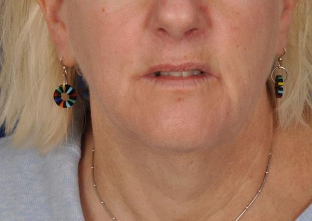 Deep Plane Facelift before at Edmon P. Khoury, MD in Greenwood Village, CO