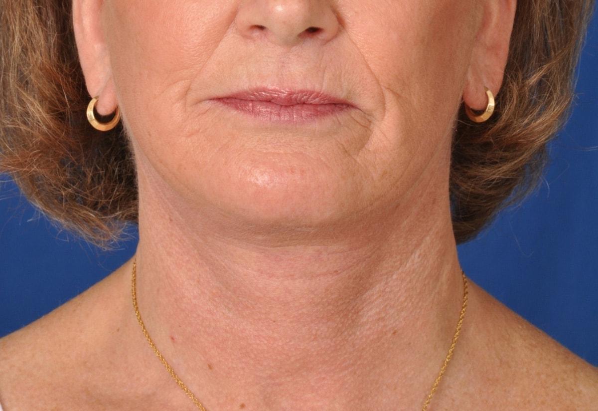 Edmon P. Khoury, MD facelift after — Greenwood Village, CO