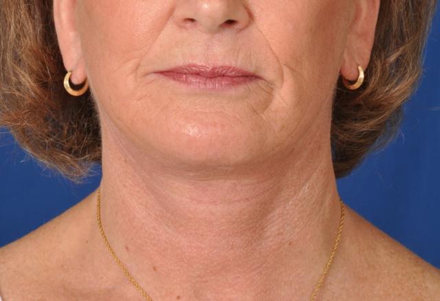 Deep Plane Facelift after at Edmon P. Khoury, MD in Greenwood Village, CO