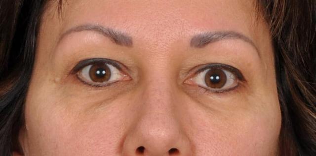 Blepharoplasty before at Edmon P. Khoury, MD in Greenwood Village, CO