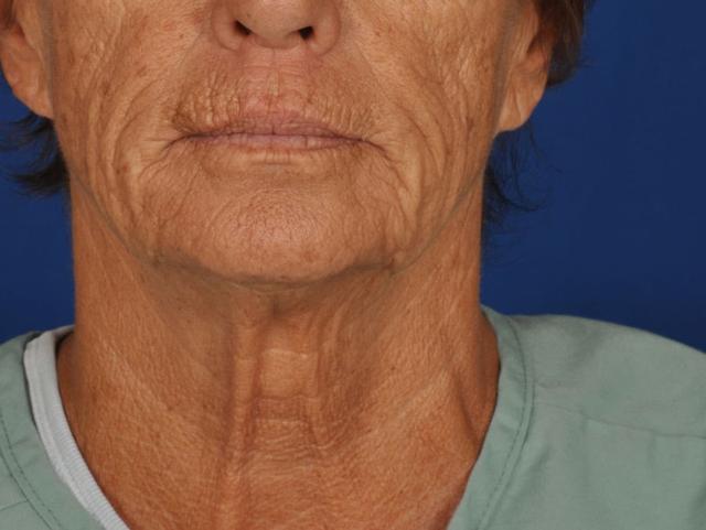 Deep Plane Facelift before at Edmon P. Khoury, MD in Greenwood Village, CO