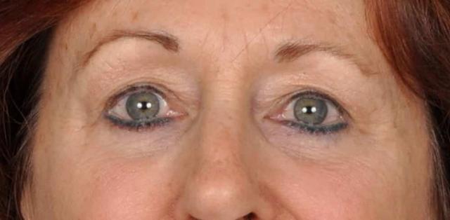 Blepharoplasty after at Edmon P. Khoury, MD in Greenwood Village, CO
