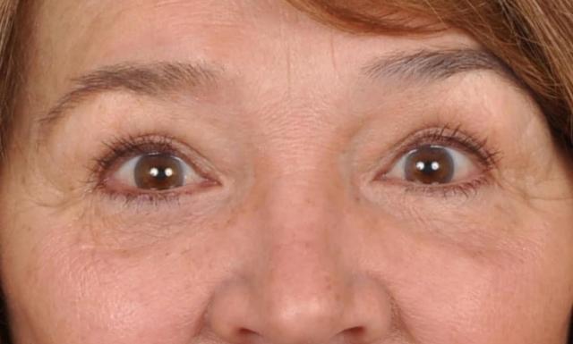 Blepharoplasty after at Edmon P. Khoury, MD in Greenwood Village, CO