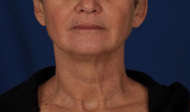 Deep Plane Facelift before at Edmon P. Khoury, MD in Greenwood Village, CO