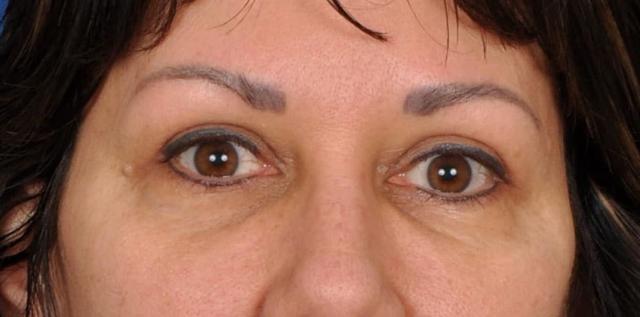 Blepharoplasty after at Edmon P. Khoury, MD in Greenwood Village, CO