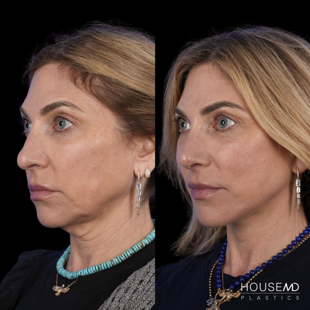 HouseMD Plastics facelift result — Palo Alto, CA