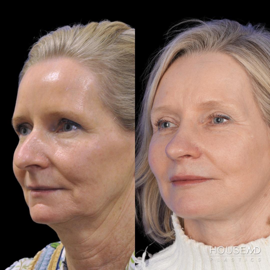 HouseMD Plastics facelift result — Palo Alto, CA