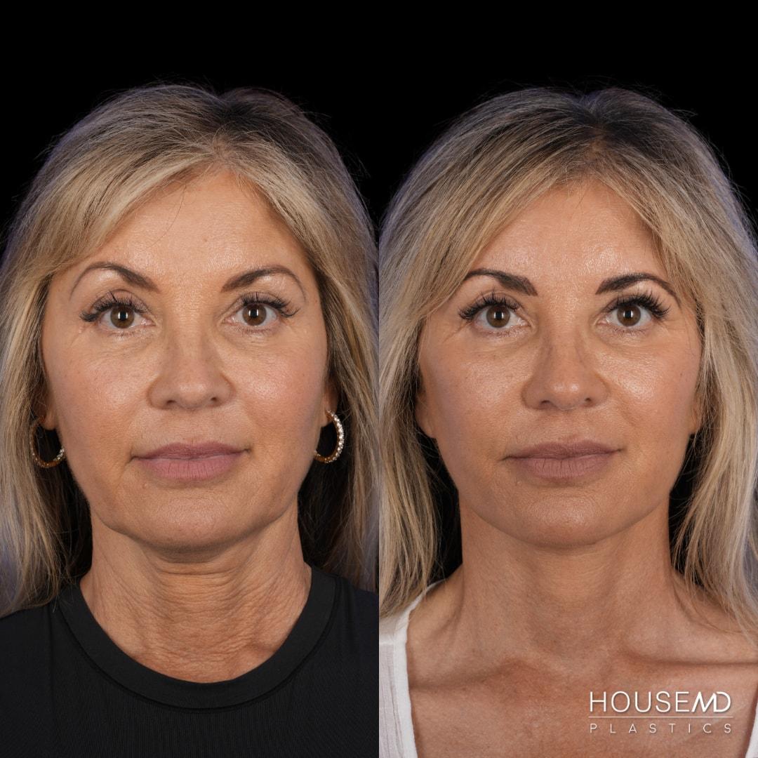 HouseMD Plastics fat transfer result — Palo Alto, CA