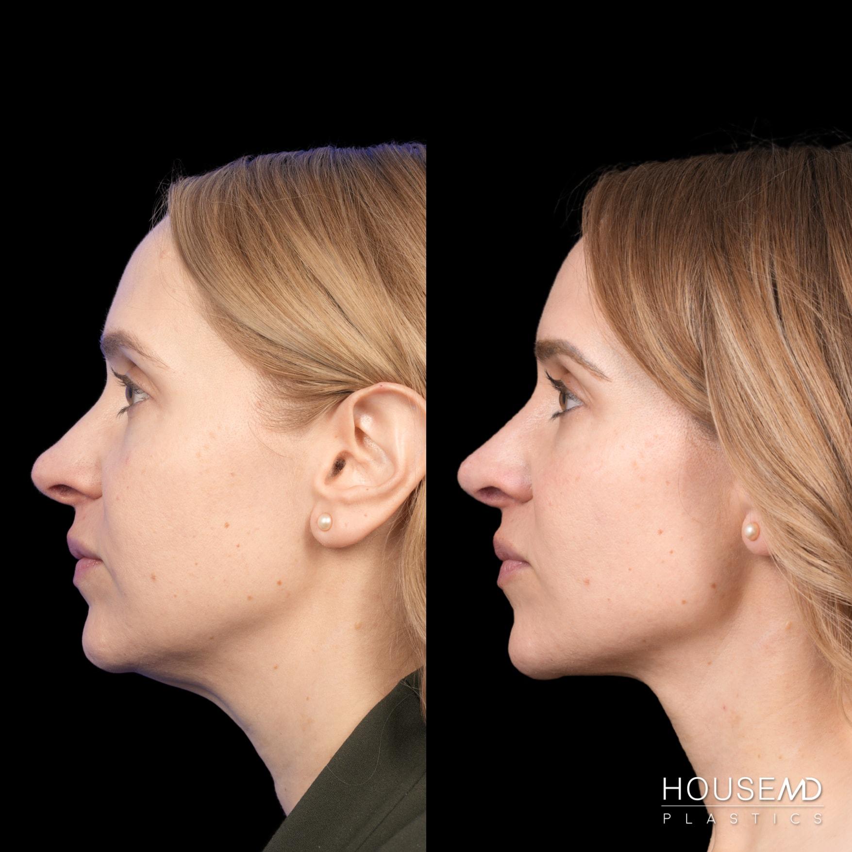 HouseMD Plastics neck lift result — Palo Alto, CA