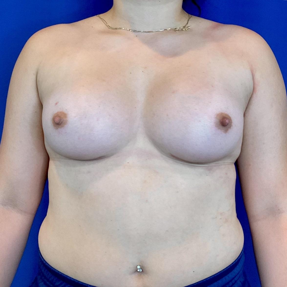Farris Plastic Surgery breast augmentation after — Dallas, TX