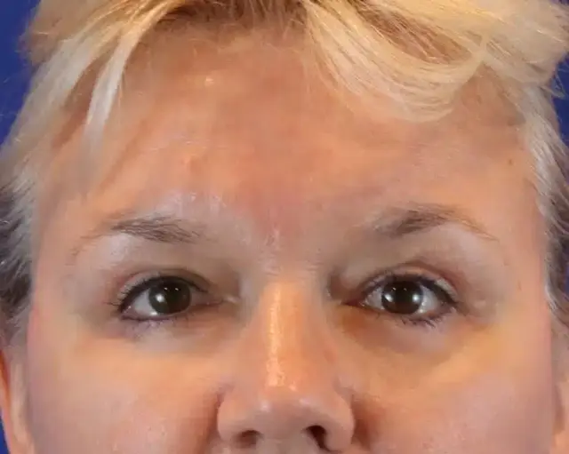 Blepharoplasty after at Farris Plastic Surgery in Dallas, TX