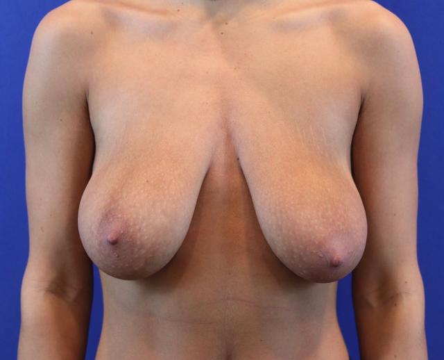 Breast Lift before at Farris Plastic Surgery in Dallas, TX