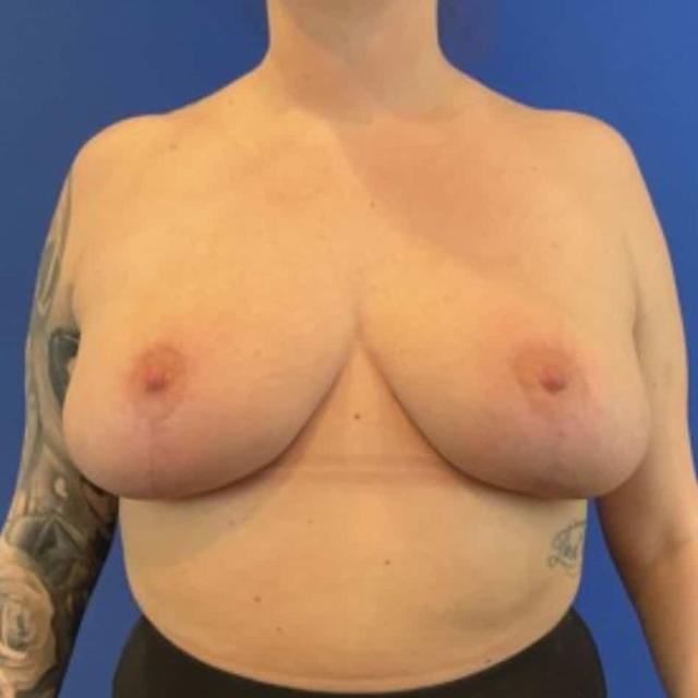 Breast Reduction after at Farris Plastic Surgery in Dallas, TX