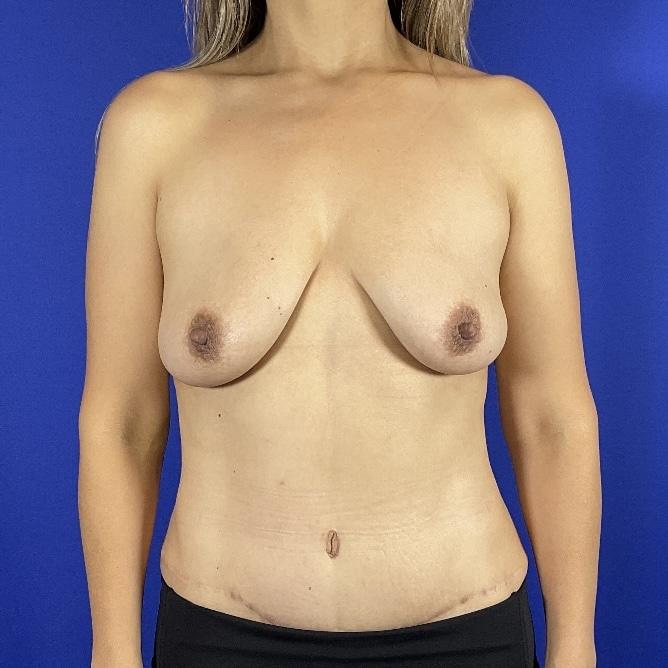 Farris Plastic Surgery liposuction after — Dallas, TX