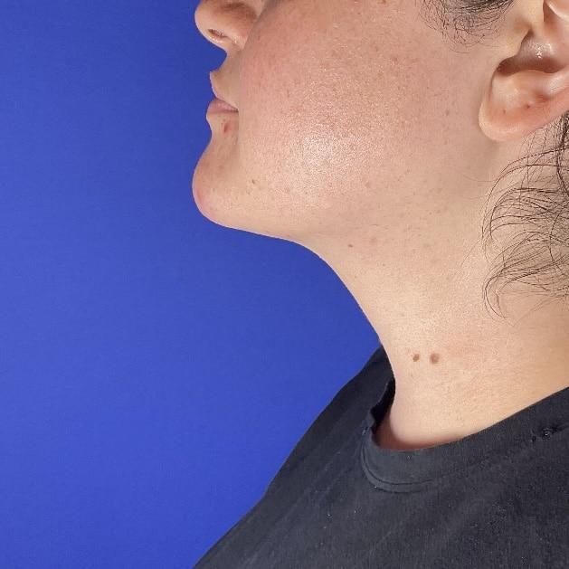 Farris Plastic Surgery liposuction after — Dallas, TX