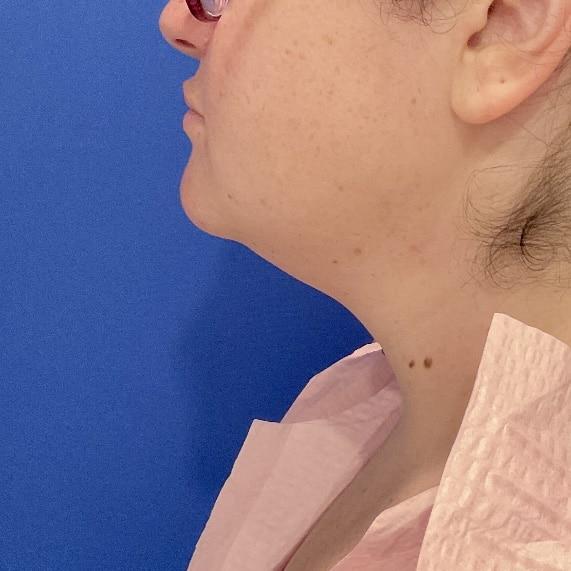 Neck Liposuction before at Farris Plastic Surgery in Dallas, TX
