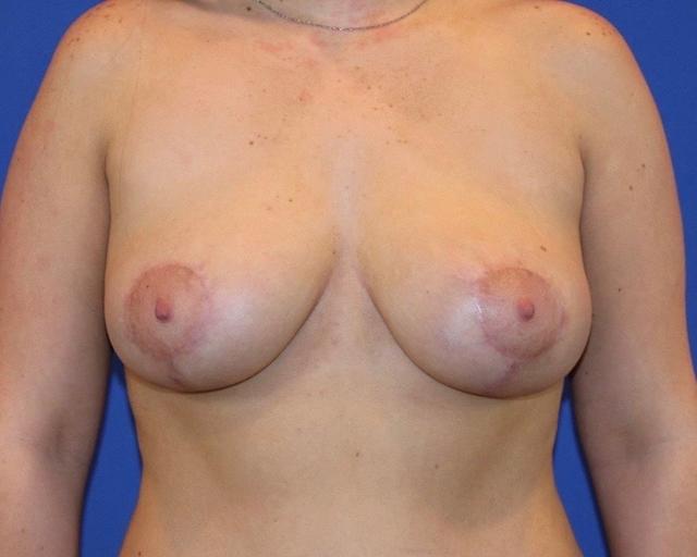 Breast Lift after at Farris Plastic Surgery in Dallas, TX