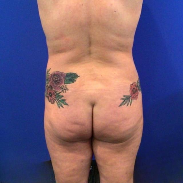 Brazilian Butt Lift before at Farris Plastic Surgery in Dallas, TX
