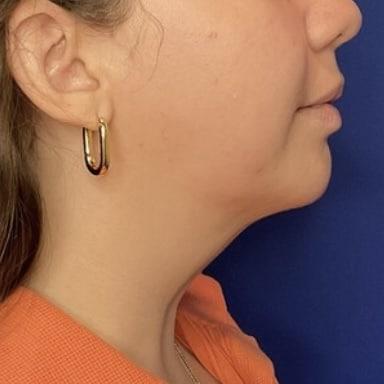 Liposuction after at Farris Plastic Surgery in Dallas, TX