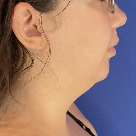 Liposuction before at Farris Plastic Surgery in Dallas, TX