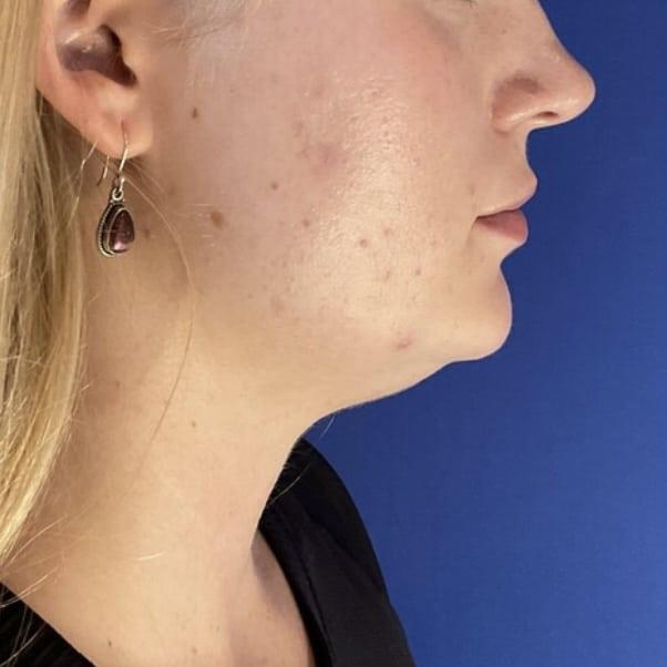 Liposuction before at Farris Plastic Surgery in Dallas, TX