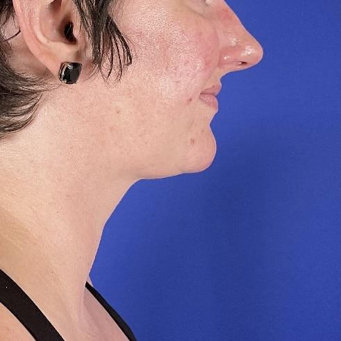 Farris Plastic Surgery liposuction after — Dallas, TX