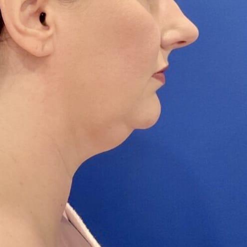 Neck Liposuction before at Farris Plastic Surgery in Dallas, TX