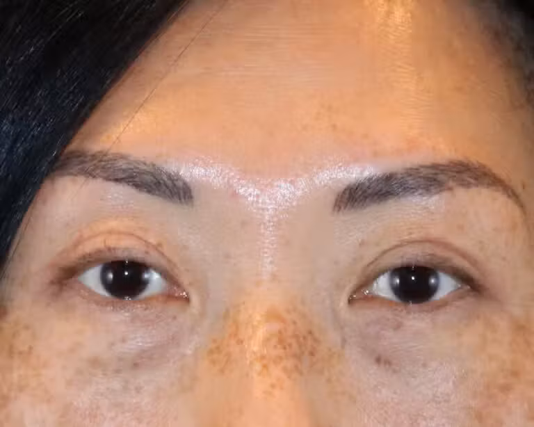 Farris Plastic Surgery blepharoplasty after — Dallas, TX