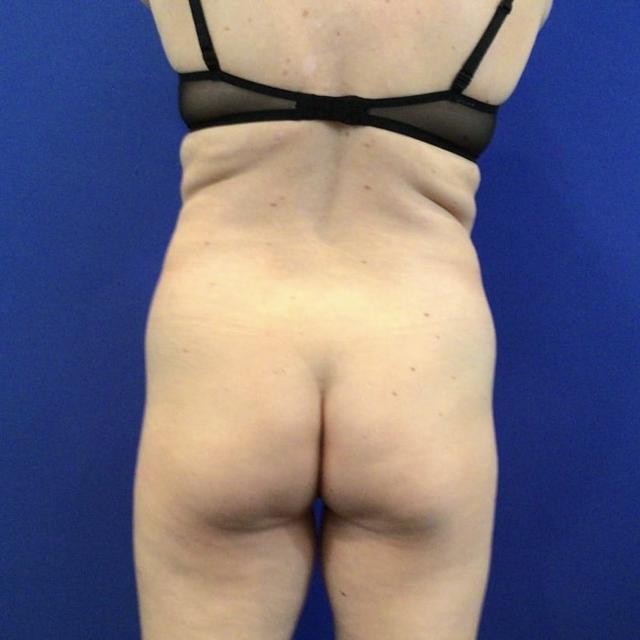 Brazilian Butt Lift before at Farris Plastic Surgery in Dallas, TX