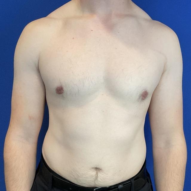 Gynecomastia Surgery after at Farris Plastic Surgery in Dallas, TX