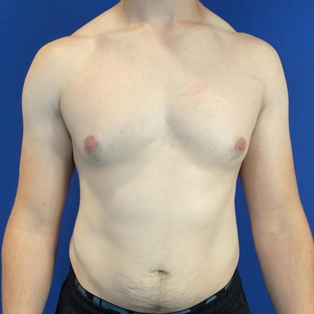 Gynecomastia Surgery before at Farris Plastic Surgery in Dallas, TX