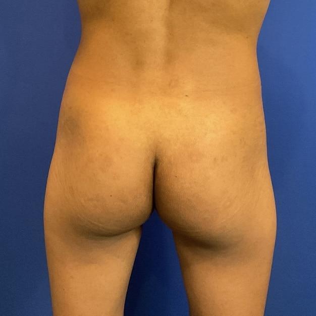 Brazilian Butt Lift before at Farris Plastic Surgery in Dallas, TX