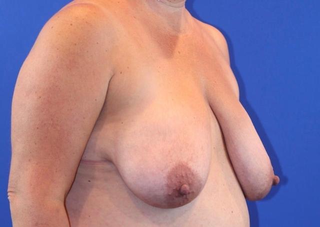 Breast Reduction before at Farris Plastic Surgery in Dallas, TX