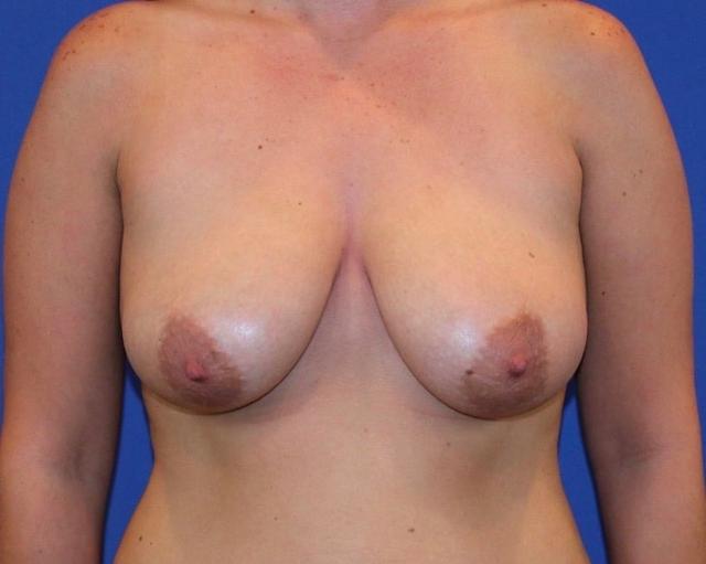 Breast Lift before at Farris Plastic Surgery in Dallas, TX