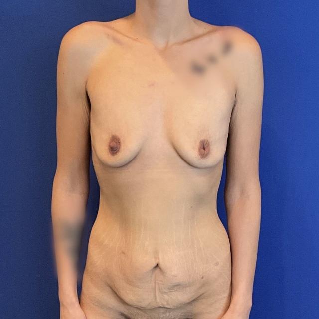 Fat Transfer Breast Augmentation before at Farris Plastic Surgery in Dallas, TX