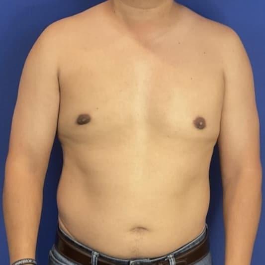 Gynecomastia Surgery after at Farris Plastic Surgery in Dallas, TX