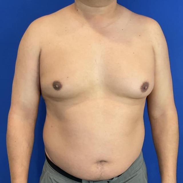 Gynecomastia Surgery before at Farris Plastic Surgery in Dallas, TX