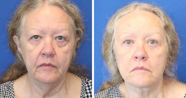 Neck Lift result at RENU by Dr. Philip S Schoenfeld (Plastic Surgeon) in Chevy Chase, MD