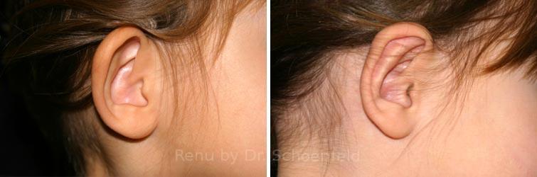 RENU by Dr. Philip S Schoenfeld (Plastic Surgeon) otoplasty result — Chevy Chase, MD