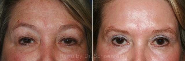 Brow Lift result at RENU by Dr. Philip S Schoenfeld (Plastic Surgeon) in Chevy Chase, MD