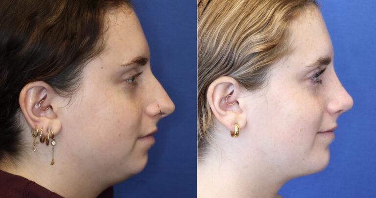 RENU by Dr. Philip S Schoenfeld (Plastic Surgeon) result — Chevy Chase, MD