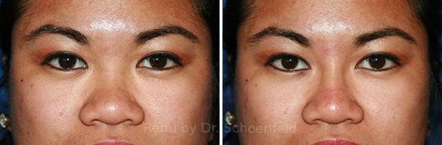 Functional Rhinoplasty result at RENU by Dr. Philip S Schoenfeld (Plastic Surgeon) in Chevy Chase, MD