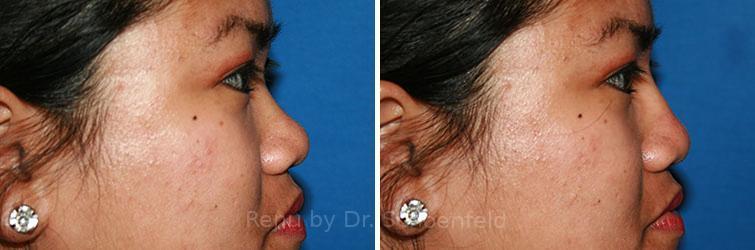 RENU by Dr. Philip S Schoenfeld (Plastic Surgeon) rhinoplasty result — Chevy Chase, MD