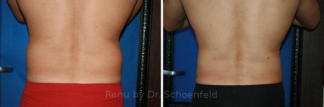 Liposuction result at RENU by Dr. Philip S Schoenfeld (Plastic Surgeon) in Chevy Chase, MD